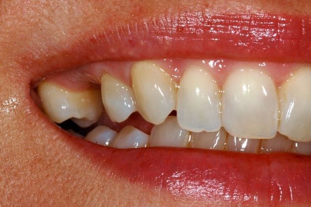 Dental Implants Patient 4 - Before