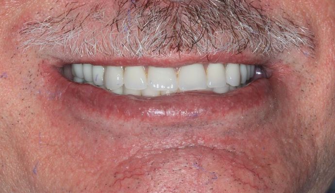 Hybrid Implant Dentures: Case 1 - Before Implant Dentures