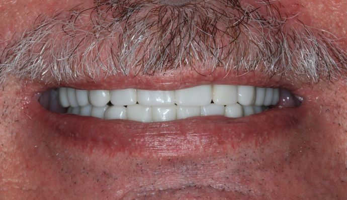 Hybrid Implant Dentures: Case 1 - After Implant Dentures