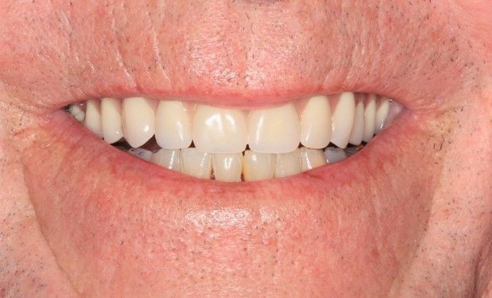 Hybrid Implant Dentures Case 2 - Before