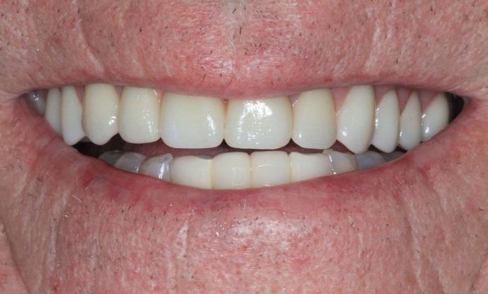 Hybrid Implant Dentures Case 2 - After