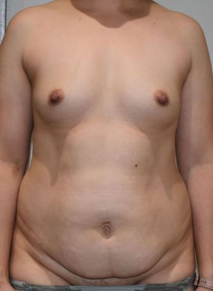 Mommy Makeover Case 209 - Before