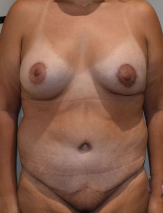 Massive Weight Loss : Case 87 - After