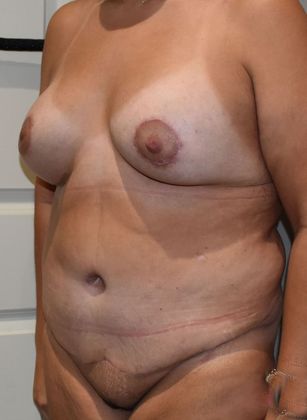 Massive Weight Loss : Case 87 - After