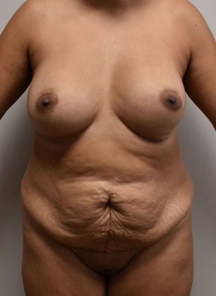 Mommy Makeover Case 211 - Before