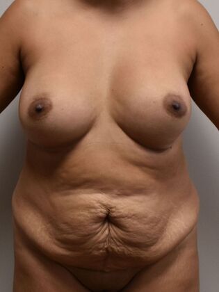 Mommy Makeover Case 211 - Before