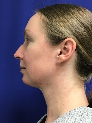 Chin / Neck Liposustion Cases