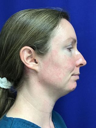 Chin / Neck Liposustion Case 1 - Before