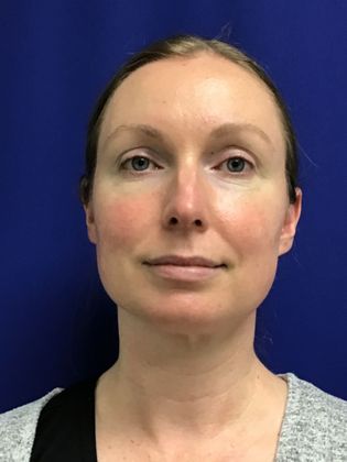 Facial Eyelid Surgery / Blepharoplasty Case 12 - After