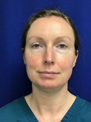 Facial Eyelid Surgery / Blepharoplasty Case 12 - Before