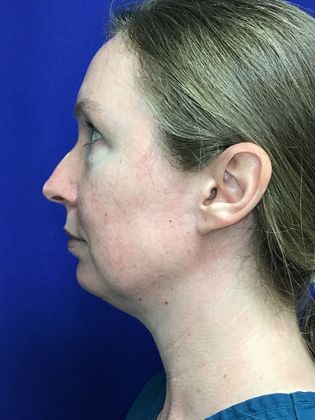 Facial Eyelid Surgery / Blepharoplasty: Case 12 - Before, convex lower eyelid bags