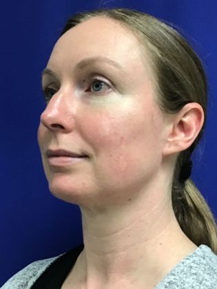 Facial Eyelid Surgery / Blepharoplasty: Case 12 - After, subtle correction