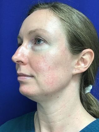 Facial Eyelid Surgery / Blepharoplasty: Case 12 - Before, convex lower eyelid bags