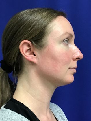 Facial Eyelid Surgery / Blepharoplasty: Case 12 - After