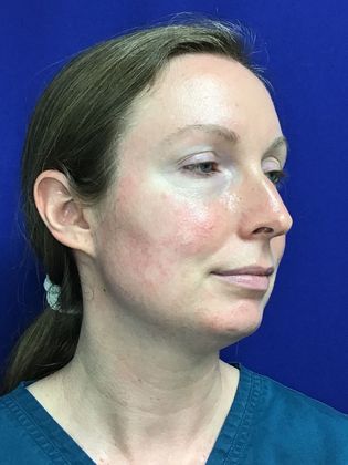 Facial Eyelid Surgery / Blepharoplasty: Case 12 - Before