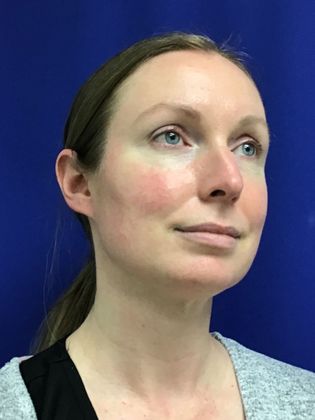 Facial Facelift / Necklift: Case 23 - After