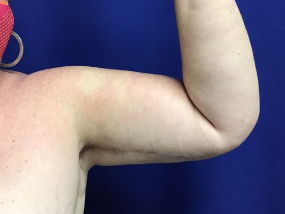 Arm Contouring / Lift Case 7 (1463611) - After