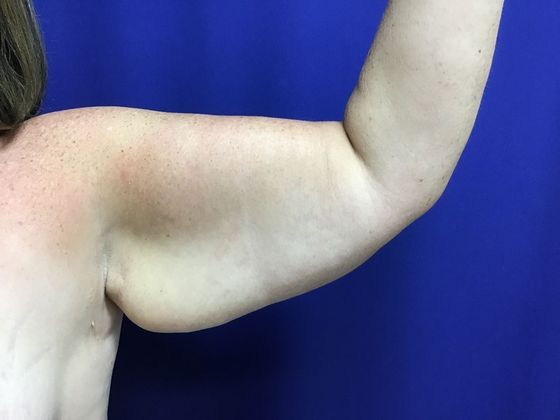 Arm Contouring / Lift Case 7 (1463611) - Before