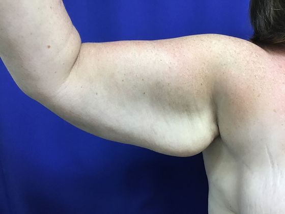 Arm Contouring / Lift: Case 7 (1463611) - Before, front