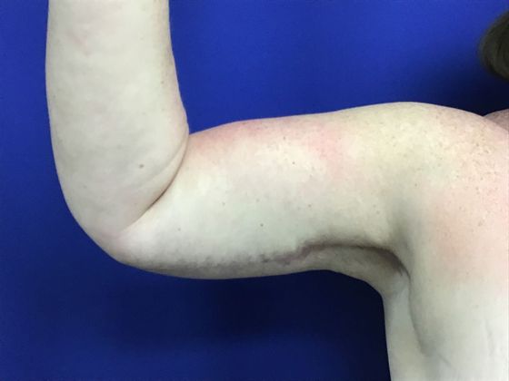 Arm Contouring / Lift: Case 7 (1463611) - After, front