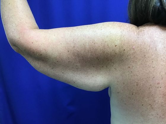 Arm Contouring / Lift: Case 7 (1463611) - Before, left, from behind