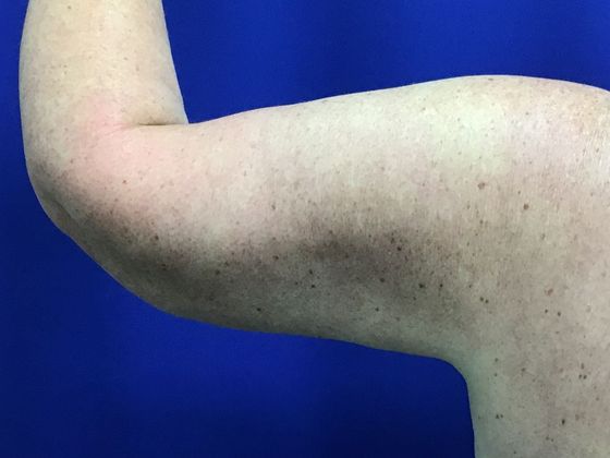 Arm Contouring / Lift: Case 7 (1463611) - After, left from behind
