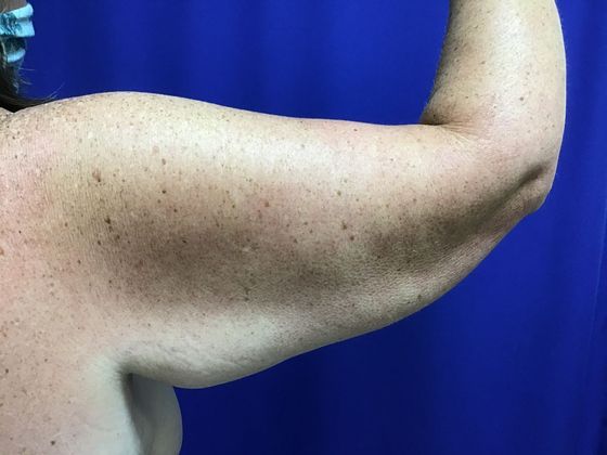 Arm Contouring / Lift: Case 7 (1463611) - Before, back