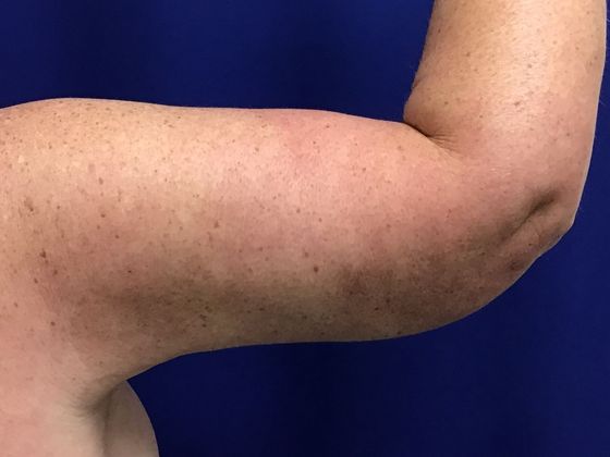 Arm Contouring / Lift: Case 7 (1463611) - After, back