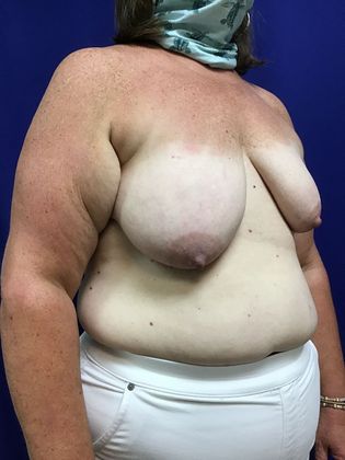 Breast Asymmetry / Deformity: Case 6 (1463611) - Before