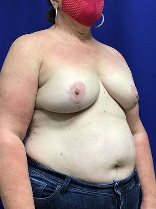 Breast Asymmetry / Deformity: Case 6 (1463611) - After