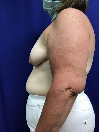 Breast Asymmetry / Deformity: Case 6 (1463611) - Before