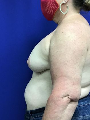 Breast Asymmetry / Deformity: Case 6 (1463611) - After