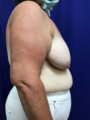 Breast Asymmetry / Deformity: Case 6 (1463611) - Before