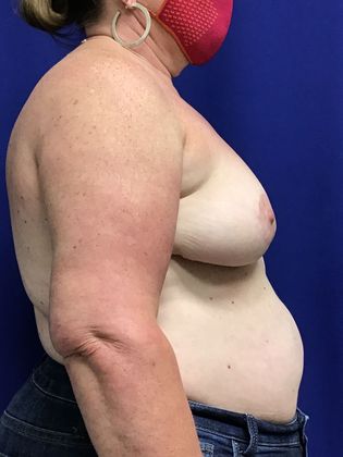 Breast Asymmetry / Deformity: Case 6 (1463611) - After