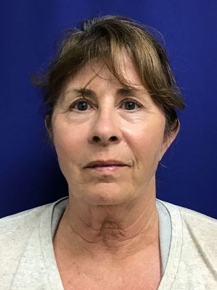 Facial Facelift / Necklift Case 24 (1118386) - After