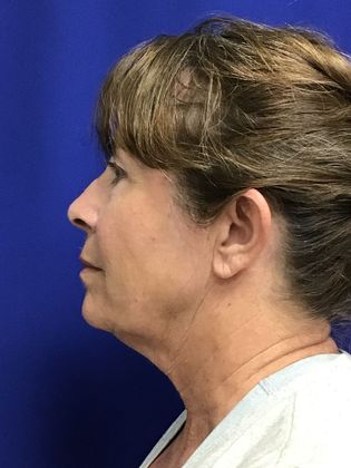 Facial Facelift / Necklift: Case 24 (1118386) - After