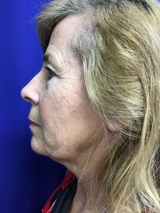 Facial Facelift / Necklift: Case 24 (1118386) - Before