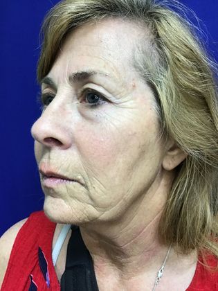 Facial Facelift / Necklift: Case 24 (1118386) - Before