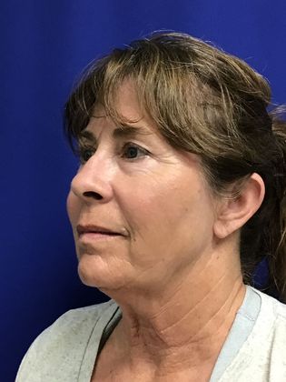 Facial Facelift / Necklift: Case 24 (1118386) - After, jowls and eyelids 
