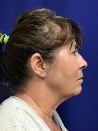 Facial Facelift / Necklift: Case 24 (1118386) - After