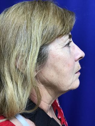 Facial Facelift / Necklift: Case 24 (1118386) - Before