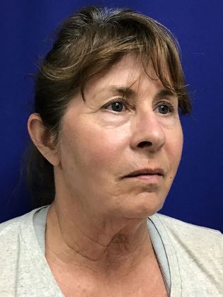 Facial Facelift / Necklift: Case 24 (1118386) - After