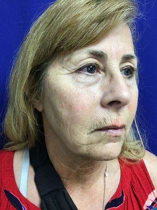Facial Facelift / Necklift: Case 24 (1118386) - Before