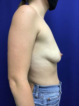 Breast Augmentation : Case 80 (1421862) - Before