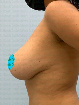 Breast Lift: Breast Lift with implant change to smaller ones - Before