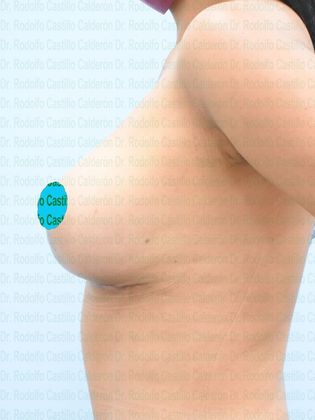 Breast Lift: Breast Lift with implant change to smaller ones - After 6 months