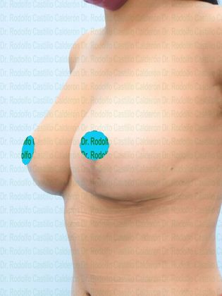 Breast Lift Breast Lift with implant change to smaller ones - After