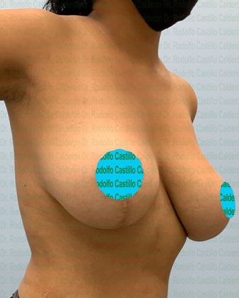 Breast Lift: Breast Lift with implant change to smaller ones - Before