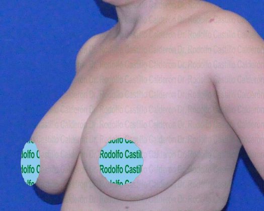 Breast Lift Implant change + Capsulectomy + Breast lift - Before