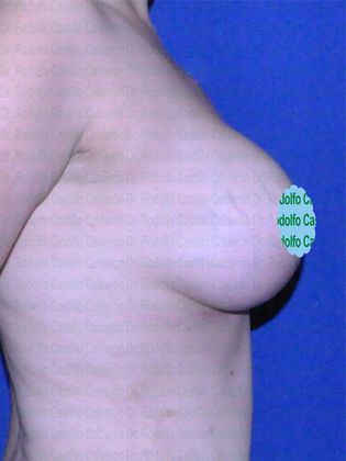 Breast Lift: Implant change + Capsulectomy + Breast lift - After 6 months